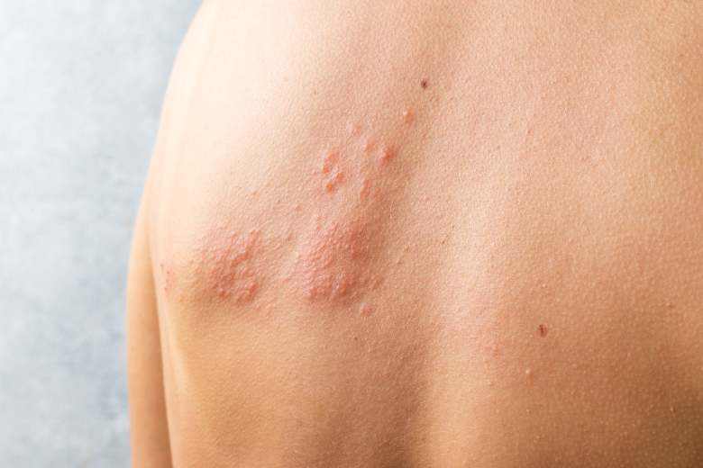 Sequelas do herpes zóster: entenda quais são e como tratar