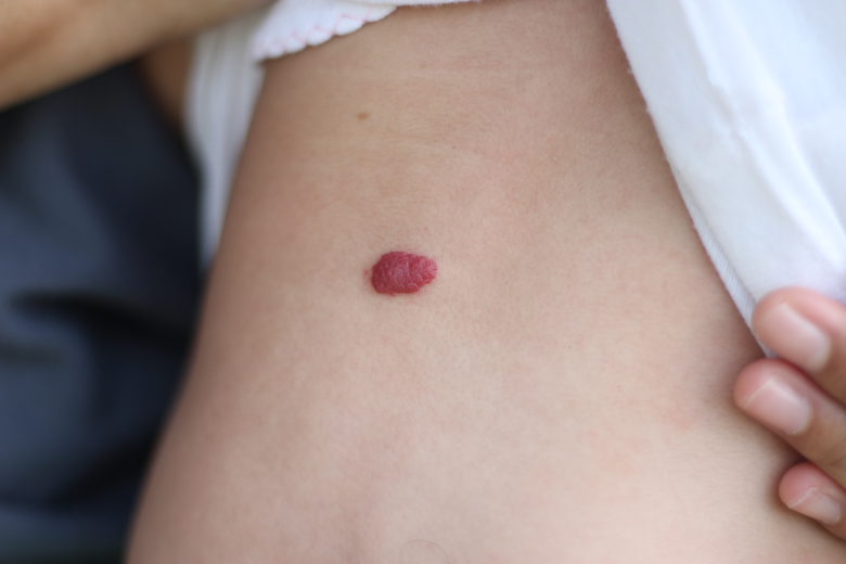 Nevo Melanocítico: entenda como esses sinais se formam no corpo